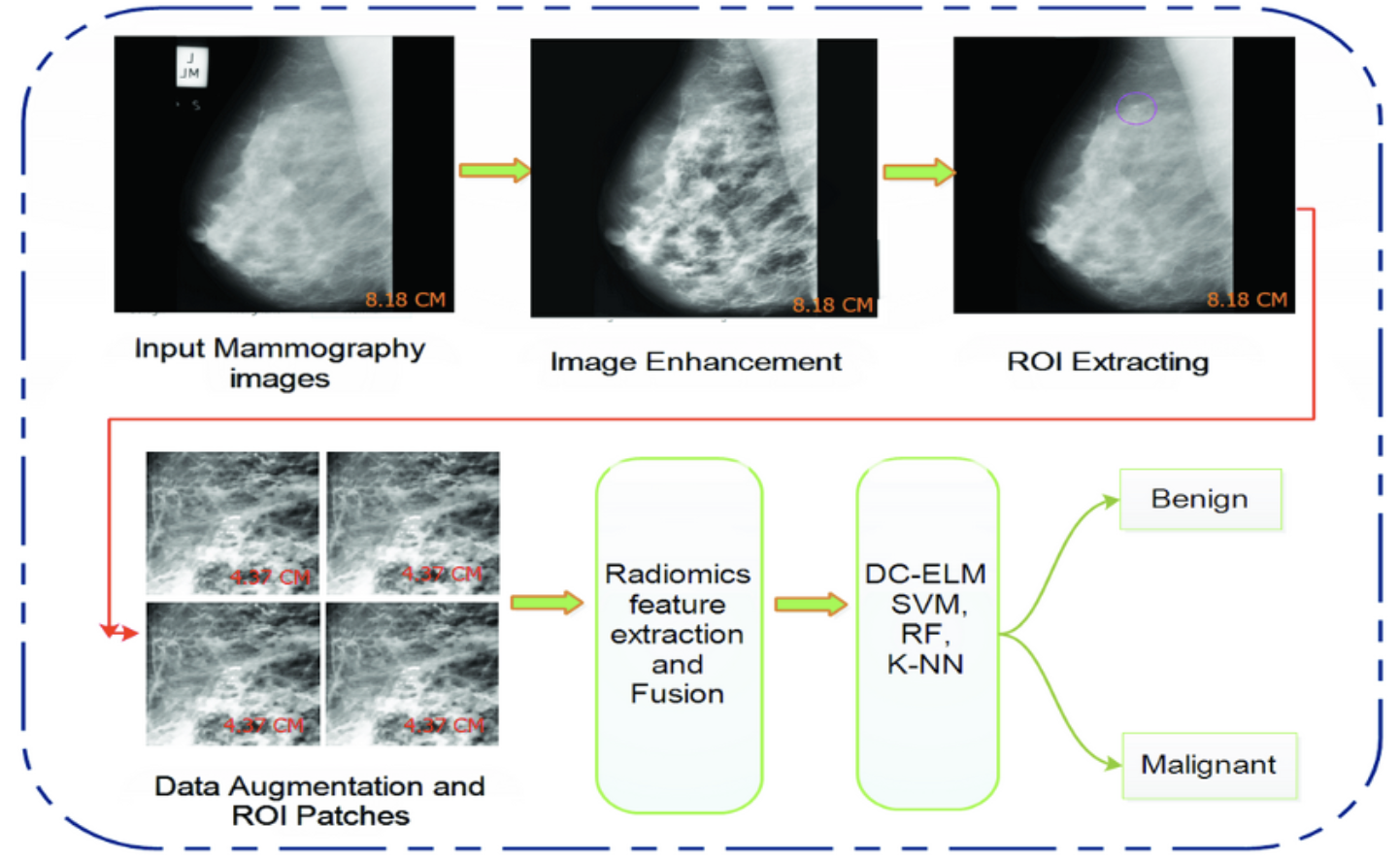 Breast Cancer and AI